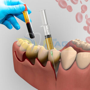 Jaw bone surgery in Sarjapur