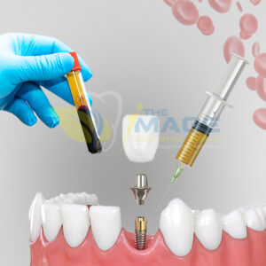 Dental Implant treatment in Hebbal