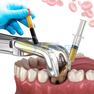 Wisdom teeth removal in Hebbal