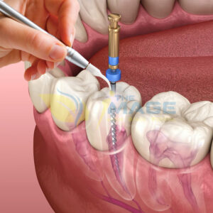 Root Canal Treatment in Hebbal