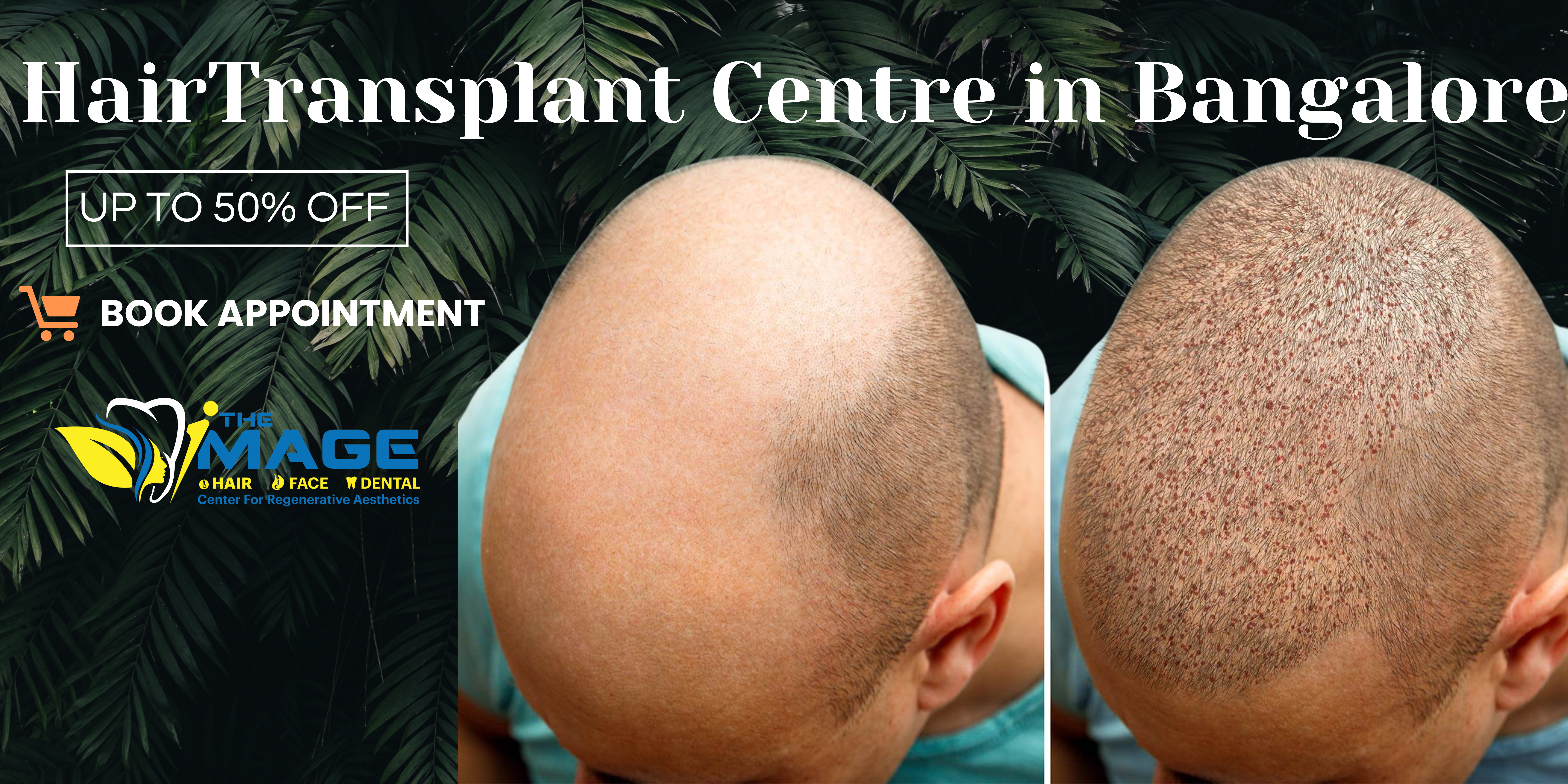 Hair Transplant