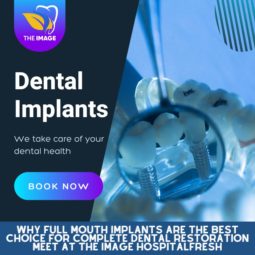 Full Mouth Implants