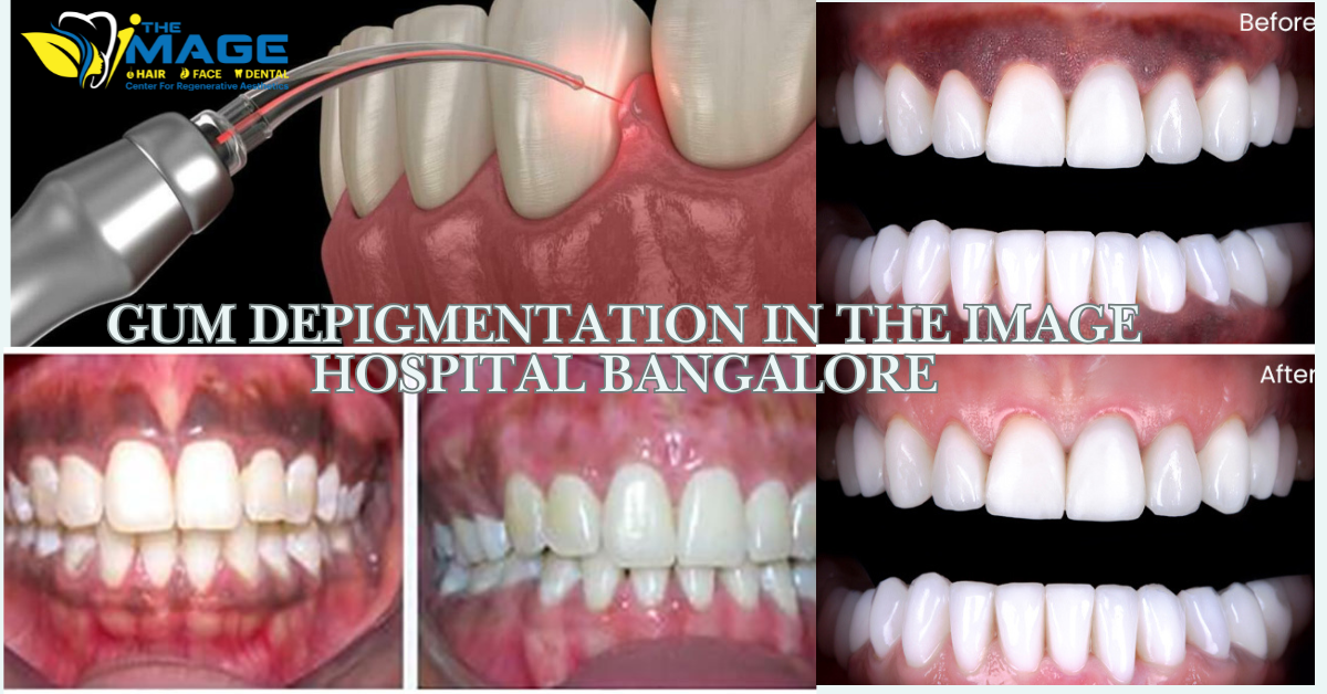 Gum Depigmentation