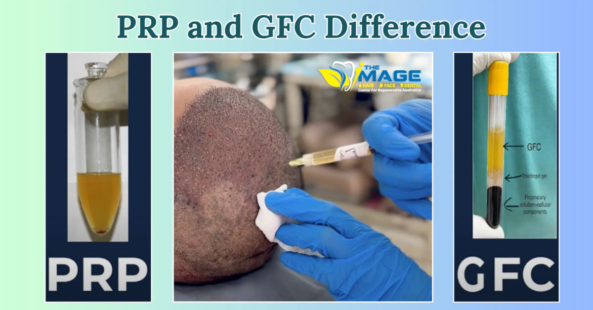 PRP and GFC Treatment