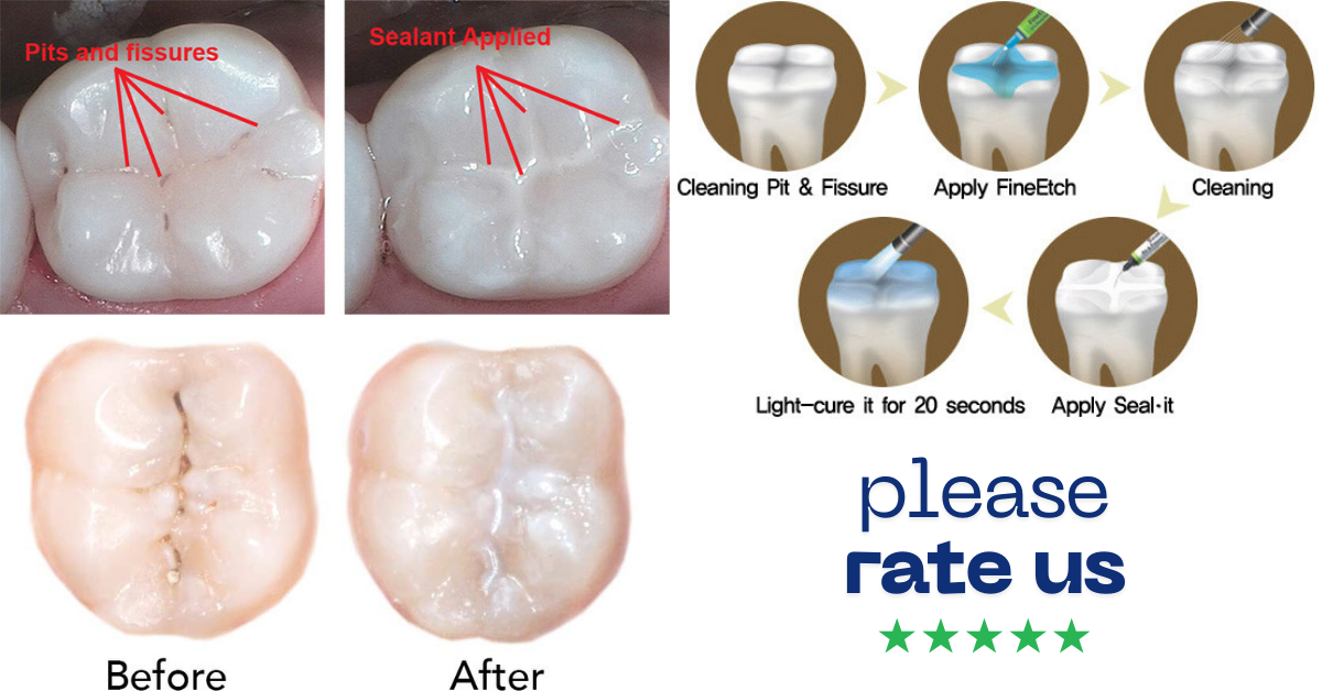Pit and Fissure Sealants