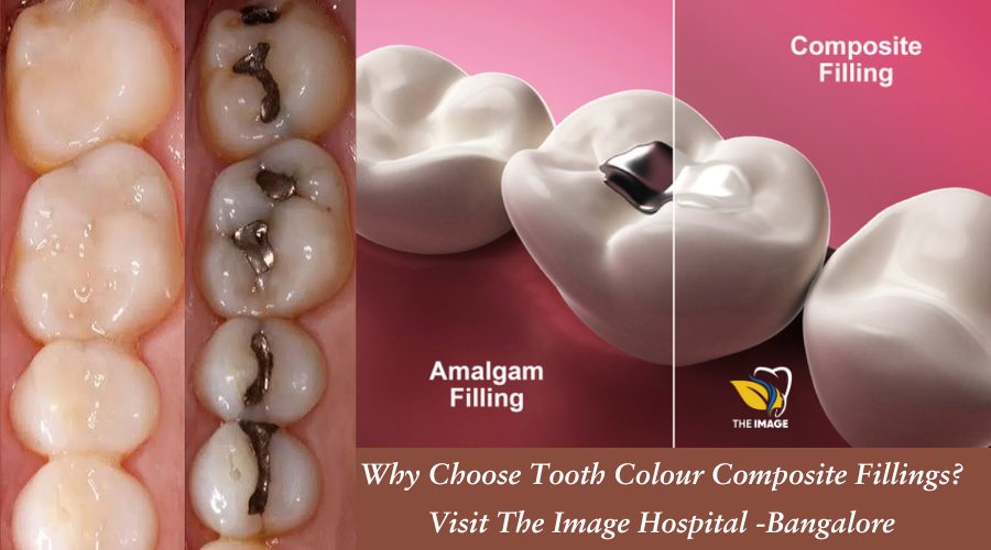 Tooth Colour Composite Fillings