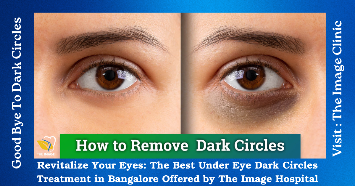 Under Eye Dark Circles Treatment in Bangalore