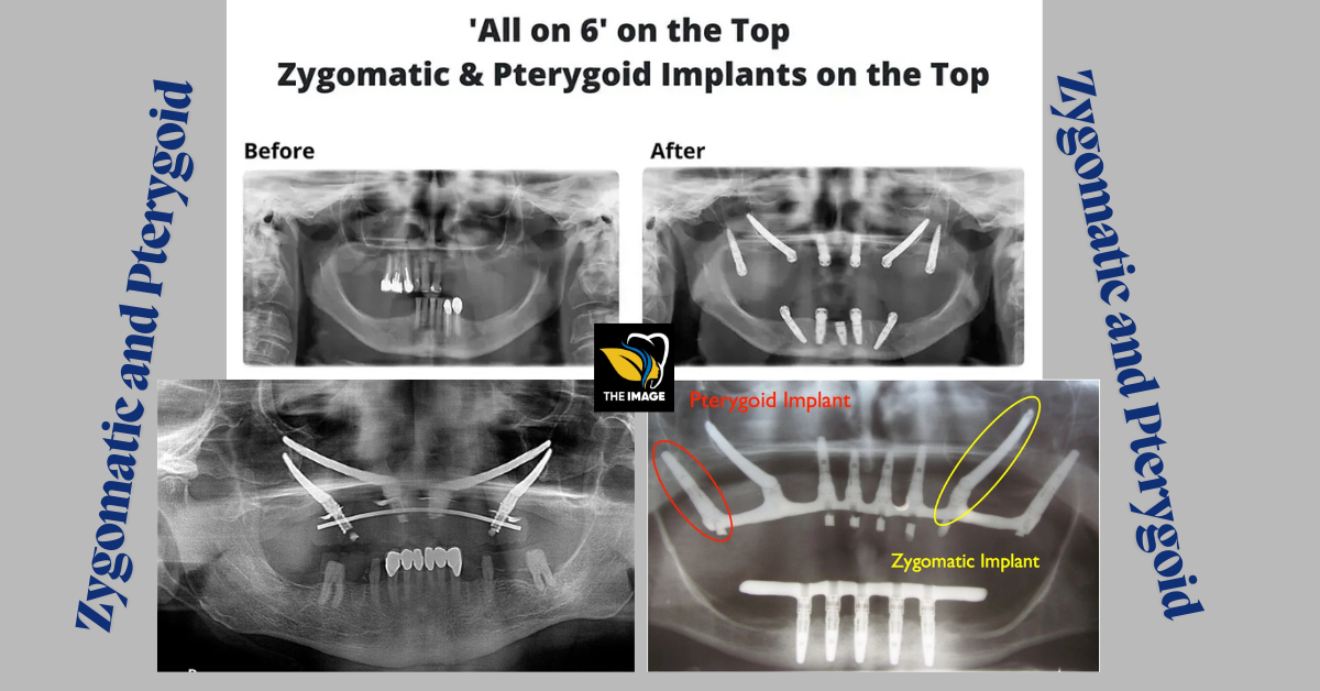Zygomatic and Pterygoid